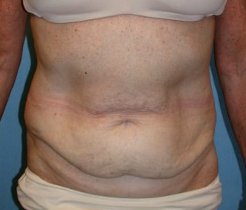 Tummy Tuck Before & After Gallery - Patient 174179759 - Image 1