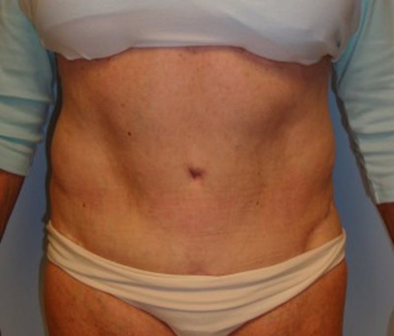 Tummy Tuck Before & After Gallery - Patient 174179759 - Image 2