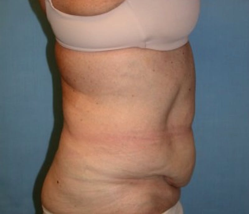 Tummy Tuck Before & After Gallery - Patient 174179759 - Image 3