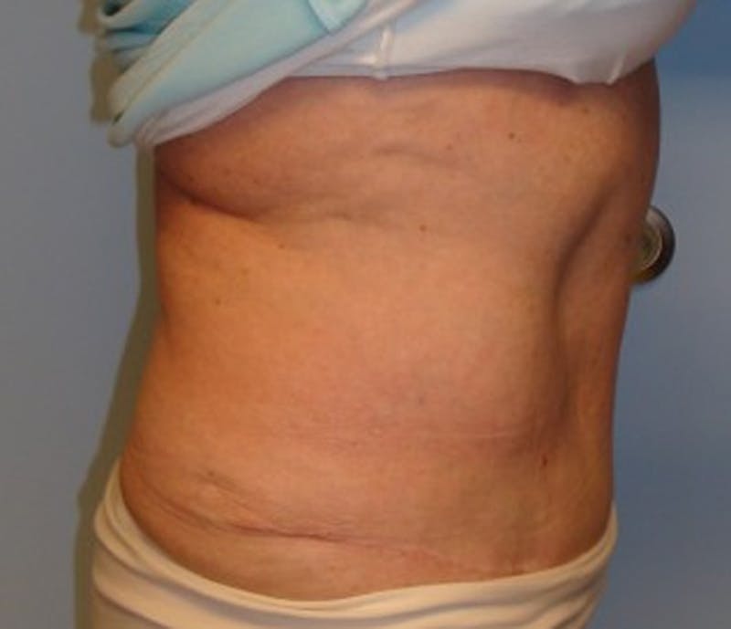 Tummy Tuck Before & After Gallery - Patient 174179759 - Image 4