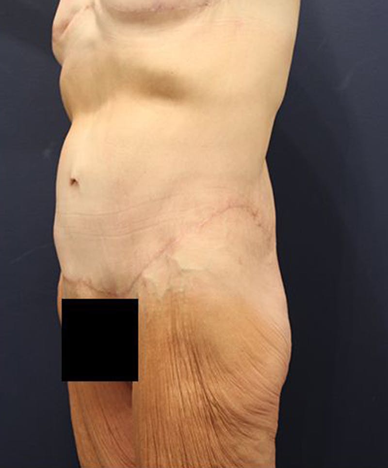 Tummy Tuck Before & After Gallery - Patient 174179761 - Image 4