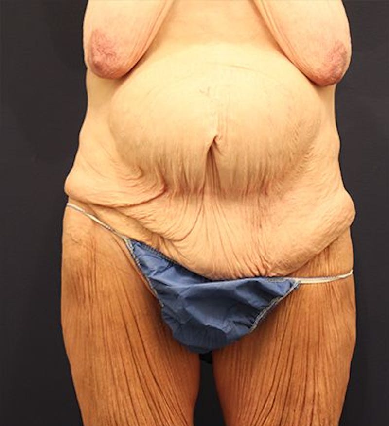 Tummy Tuck Before & After Gallery - Patient 174179761 - Image 1