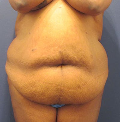 Tummy Tuck Before & After Gallery - Patient 174179762 - Image 1