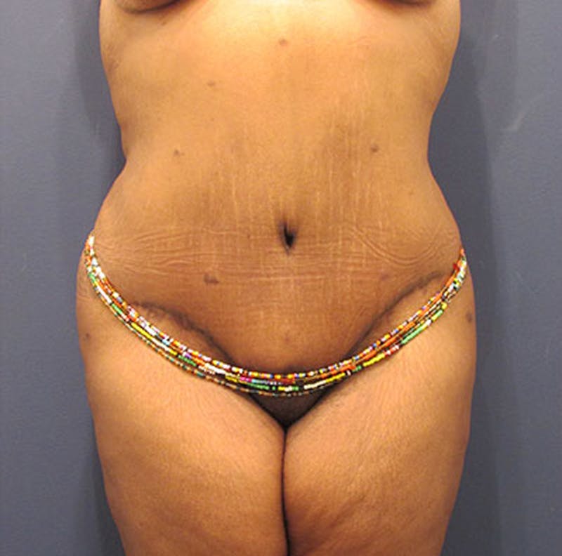 Tummy Tuck Before & After Gallery - Patient 174179762 - Image 2