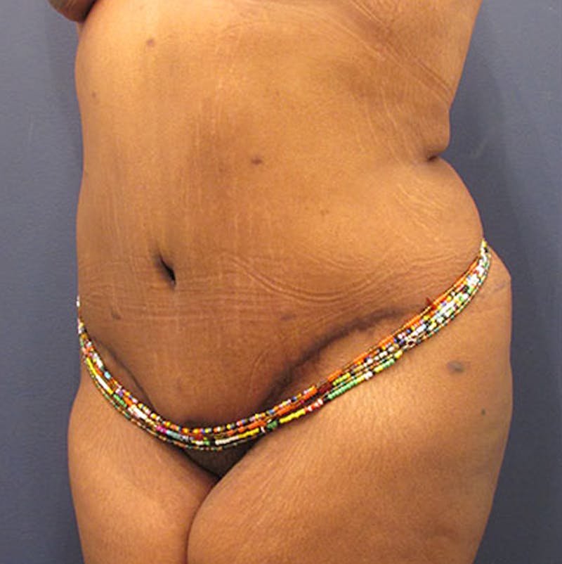 Tummy Tuck Before & After Gallery - Patient 174179762 - Image 4