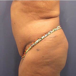 Tummy Tuck Before & After Gallery - Patient 174179762 - Image 6