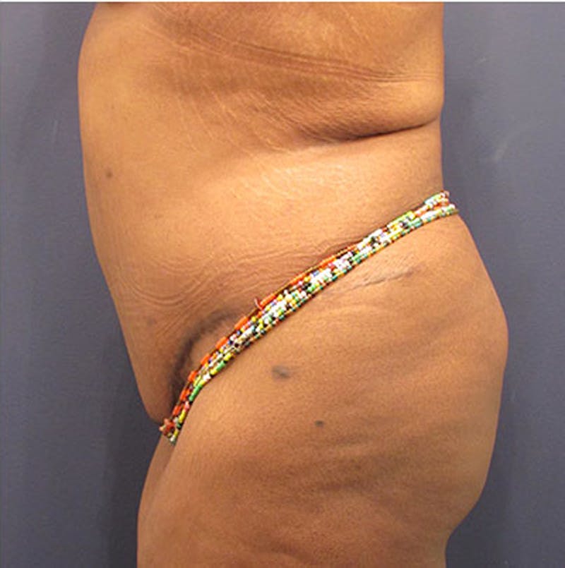 Tummy Tuck Before & After Gallery - Patient 174179762 - Image 6