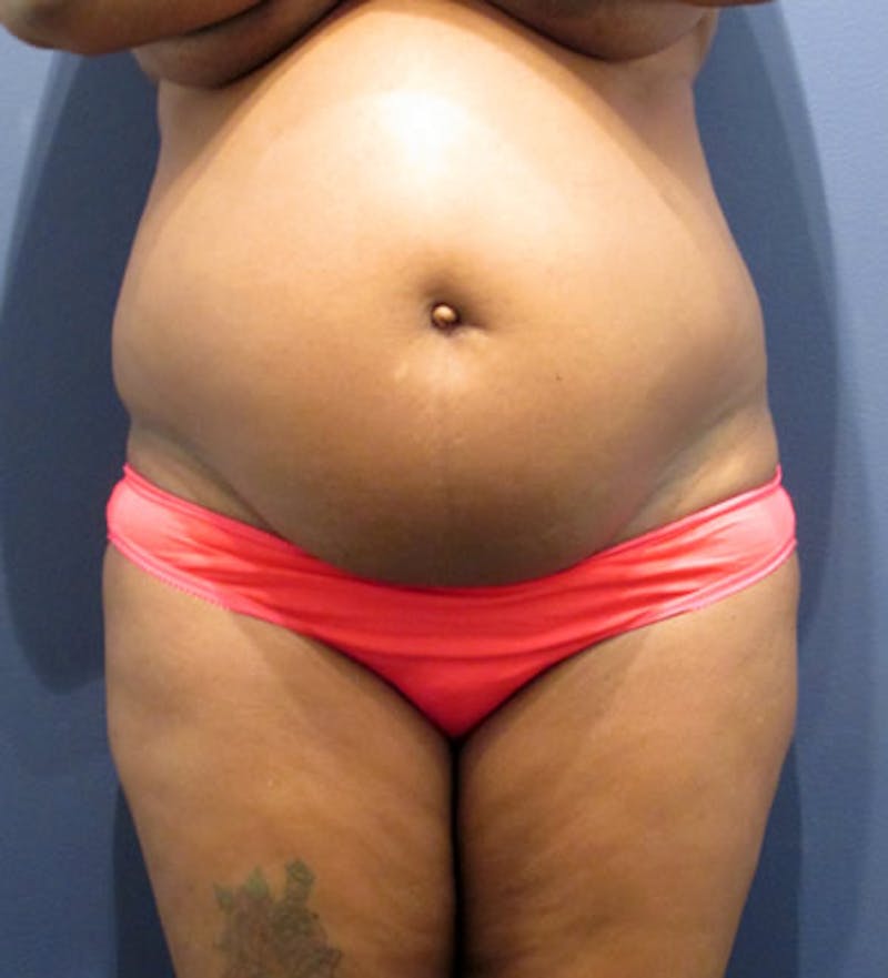 Tummy Tuck Before & After Gallery - Patient 174179763 - Image 1