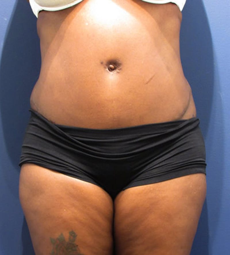 Tummy Tuck Before & After Gallery - Patient 174179763 - Image 2