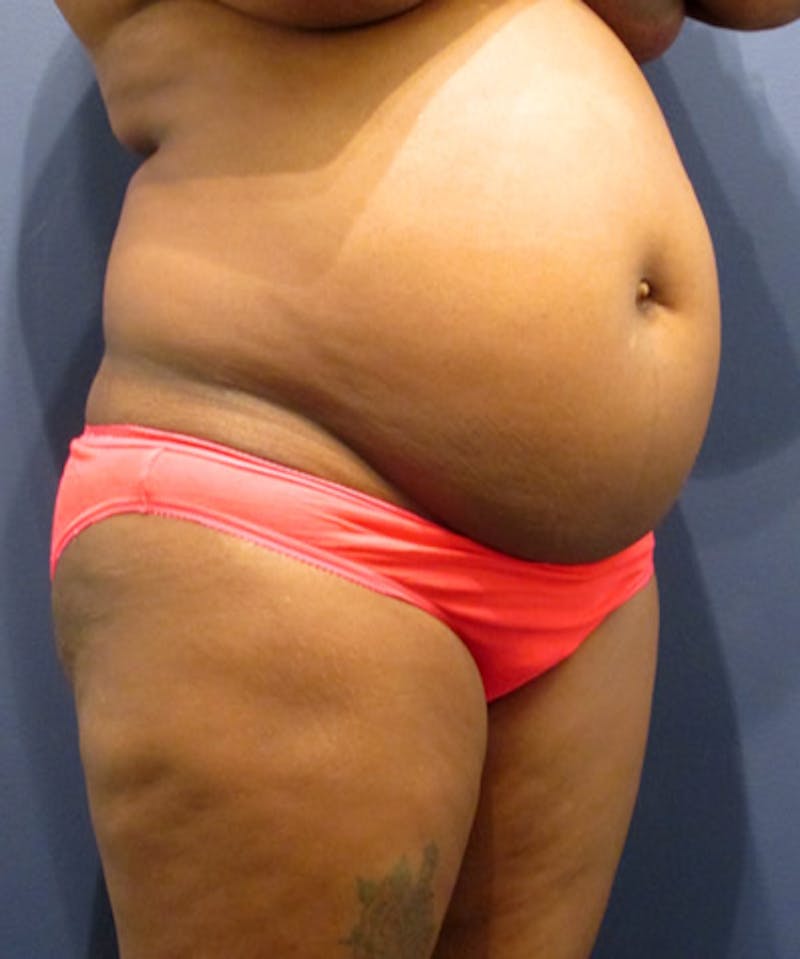 Tummy Tuck Before & After Gallery - Patient 174179763 - Image 3