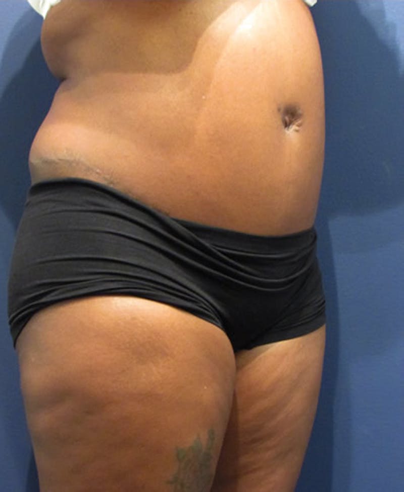Tummy Tuck Before & After Gallery - Patient 174179763 - Image 4