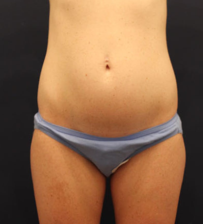 Tummy Tuck Before & After Gallery - Patient 174179765 - Image 1