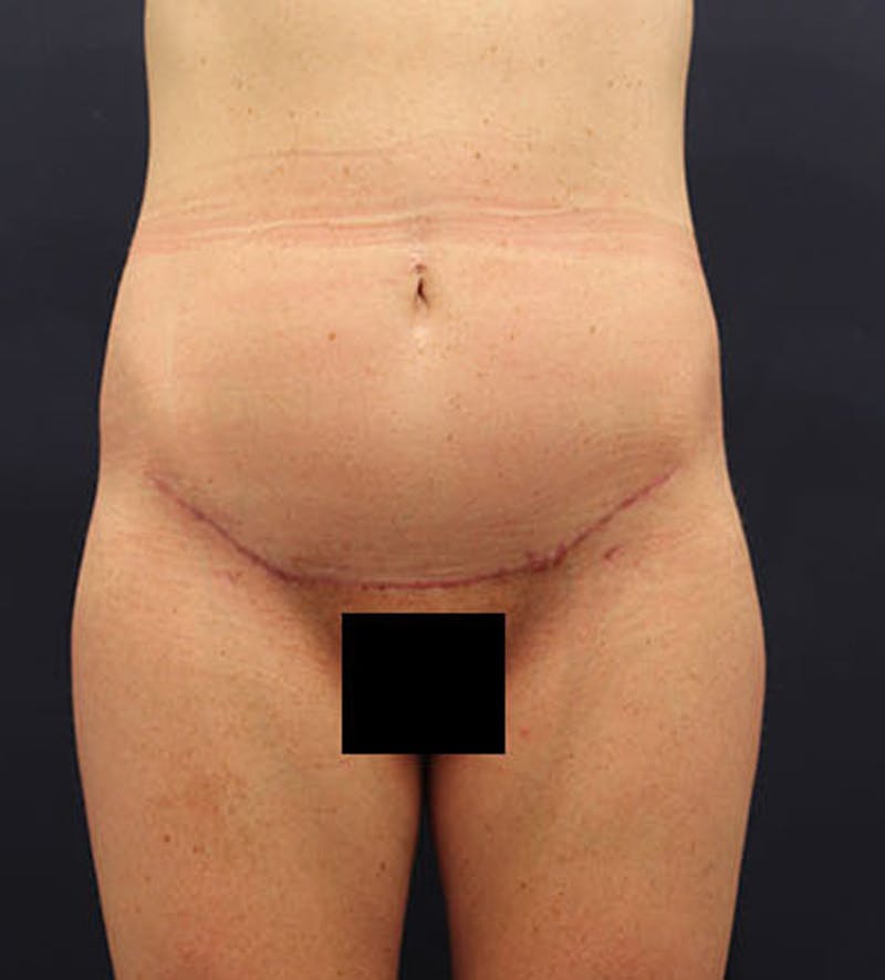 Tummy Tuck Before & After Gallery - Patient 174179765 - Image 2