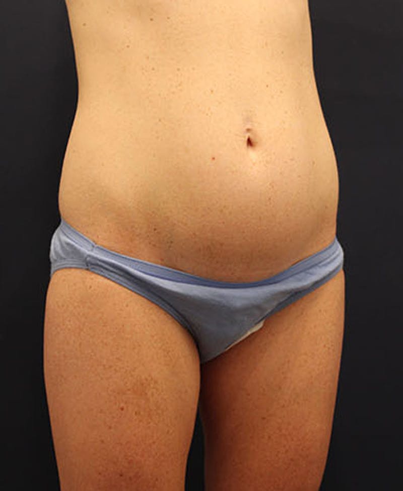 Tummy Tuck Before & After Gallery - Patient 174179765 - Image 3