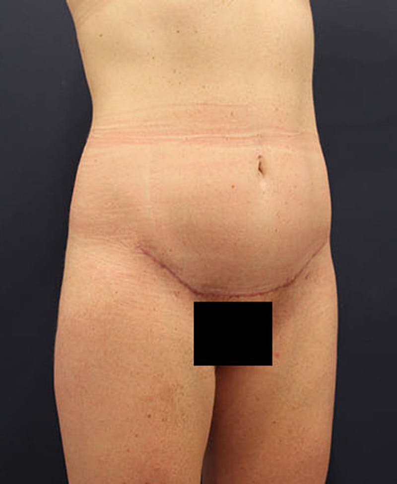 Tummy Tuck Before & After Gallery - Patient 174179765 - Image 4