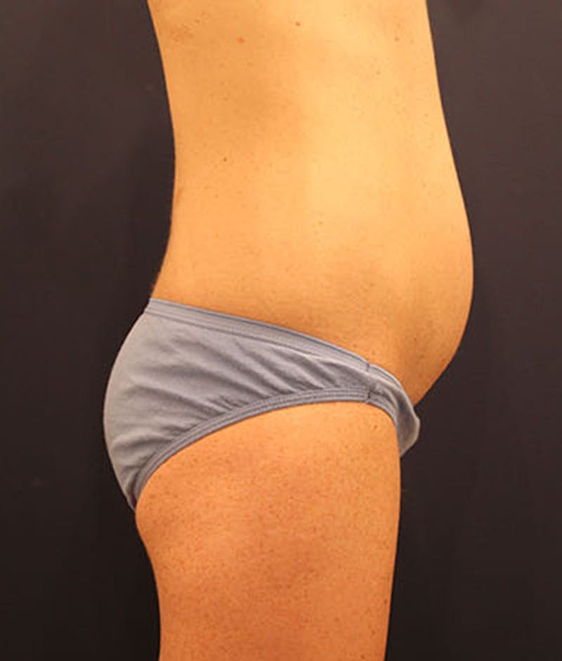 Tummy Tuck Before & After Gallery - Patient 174179765 - Image 5