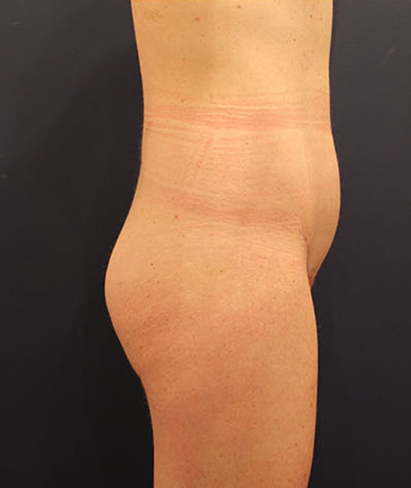 Tummy Tuck Before & After Gallery - Patient 174179765 - Image 6