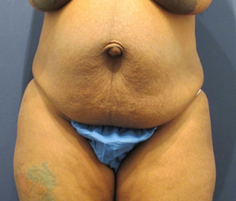 Tummy Tuck Before & After Gallery - Patient 174179766 - Image 1