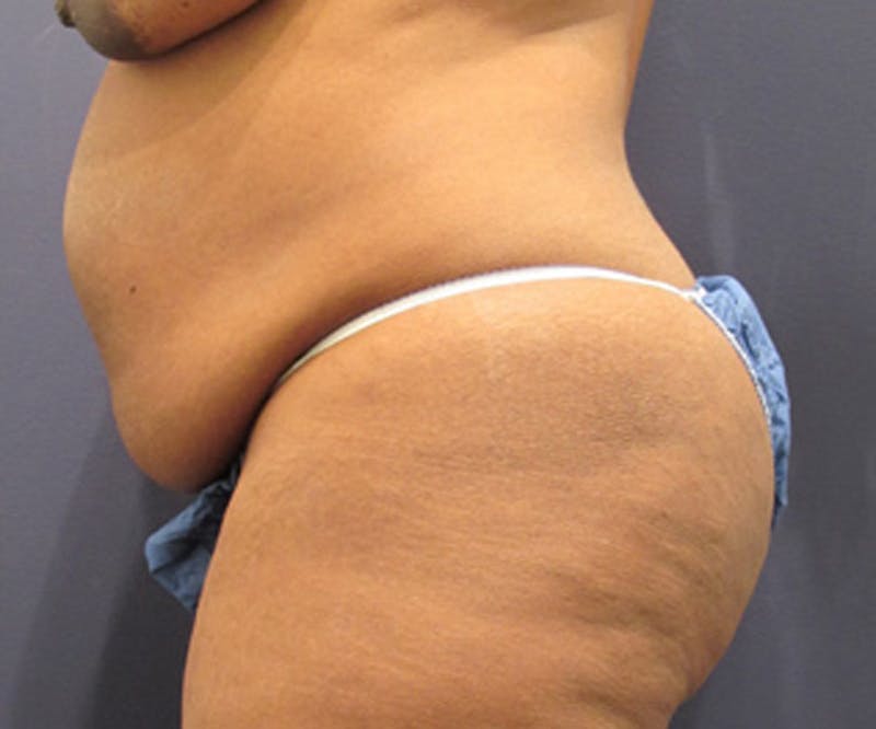 Tummy Tuck Before & After Gallery - Patient 174179766 - Image 5