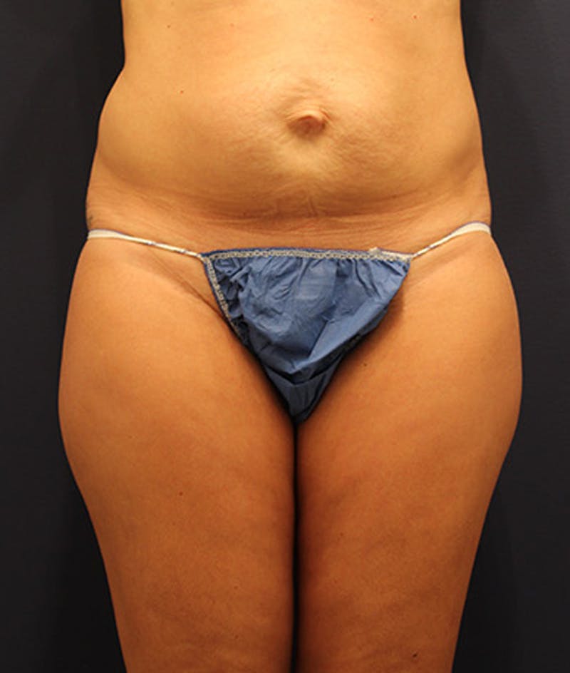 Tummy Tuck Before & After Gallery - Patient 174179767 - Image 1