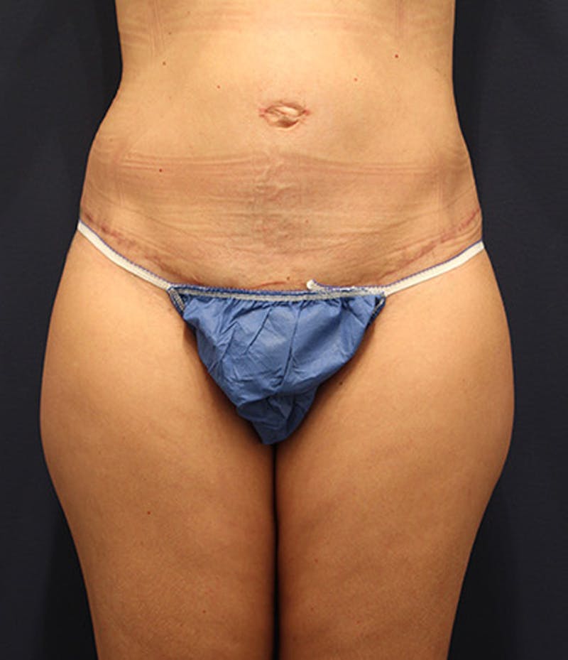 Tummy Tuck Before & After Gallery - Patient 174179767 - Image 2
