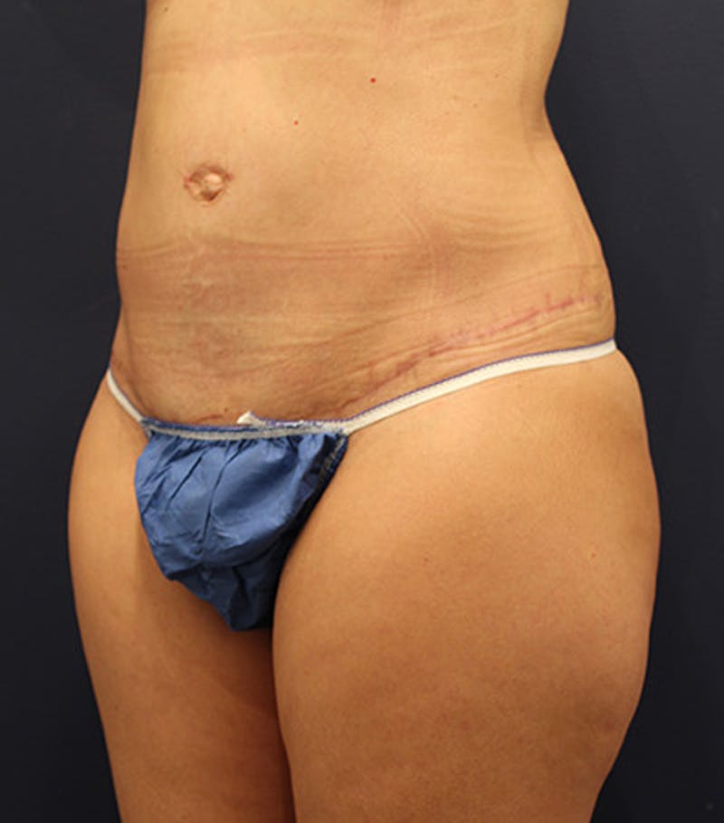 Tummy Tuck Before & After Gallery - Patient 174179767 - Image 4