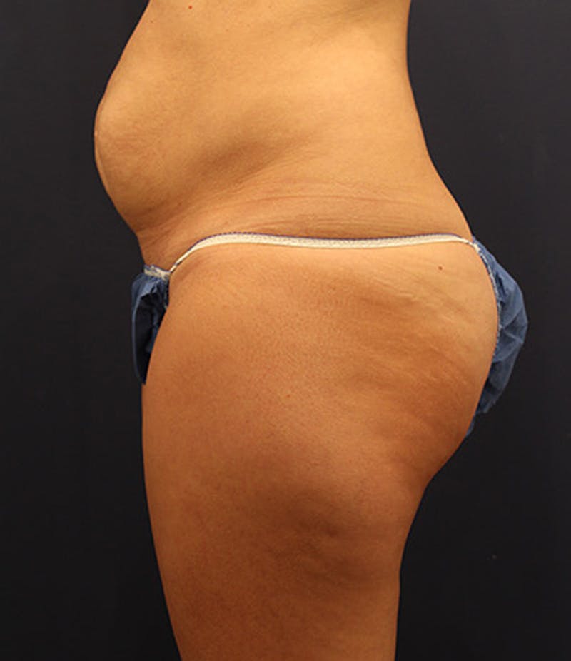 Tummy Tuck Before & After Gallery - Patient 174179767 - Image 5
