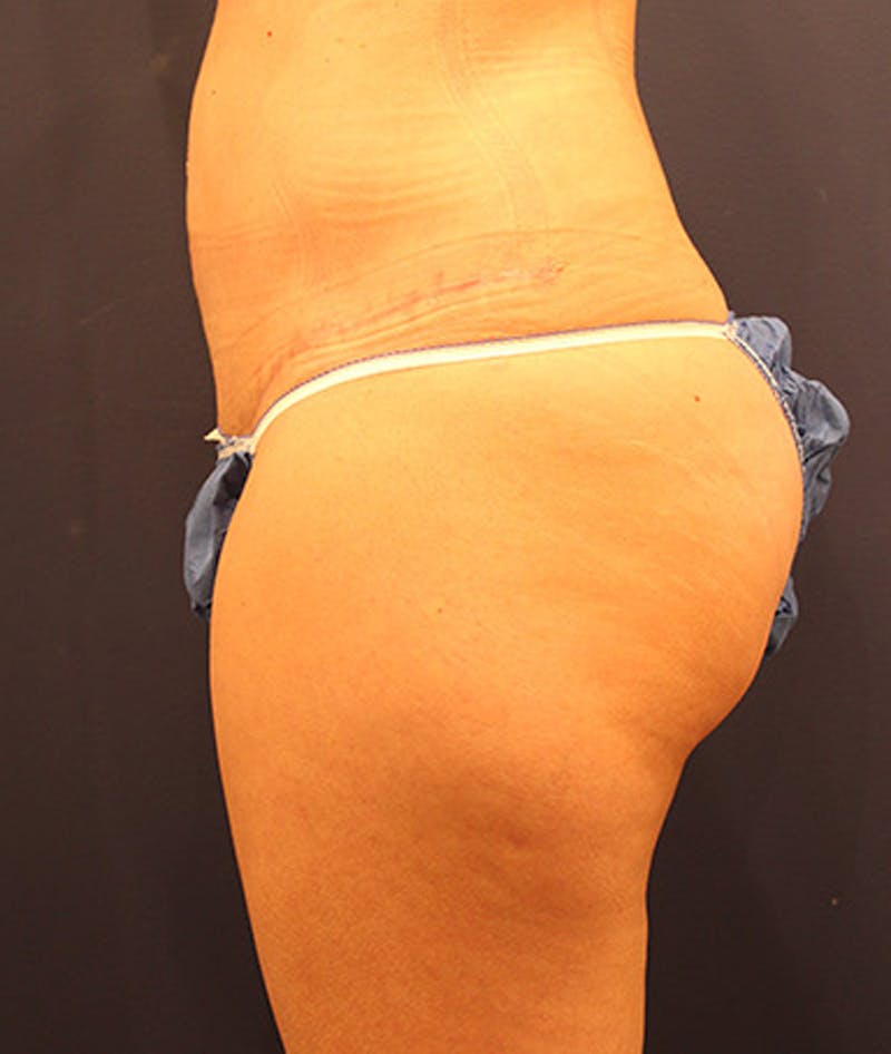 Tummy Tuck Before & After Gallery - Patient 174179767 - Image 6