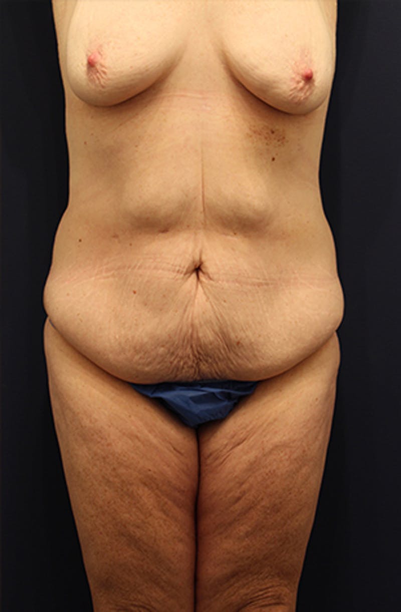 Tummy Tuck Before & After Gallery - Patient 174179769 - Image 1