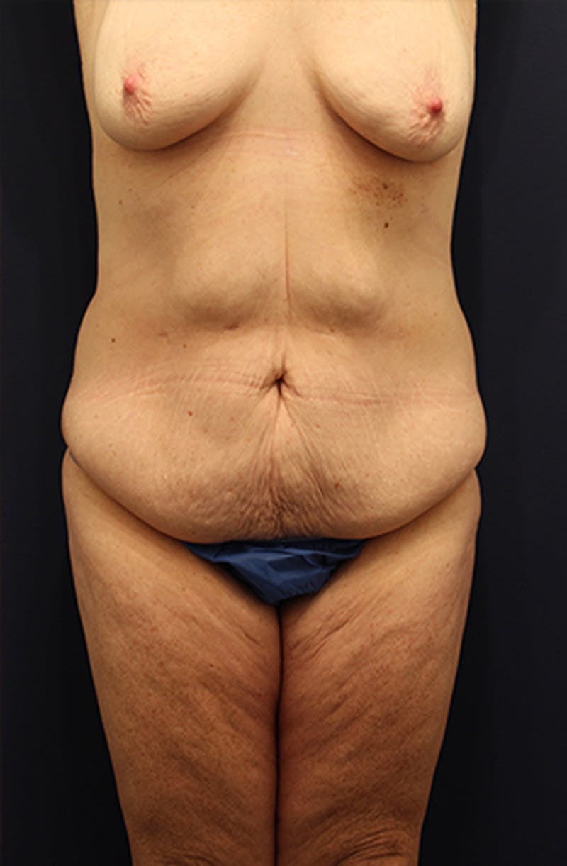 Tummy Tuck Before & After Gallery - Patient 174179769 - Image 1