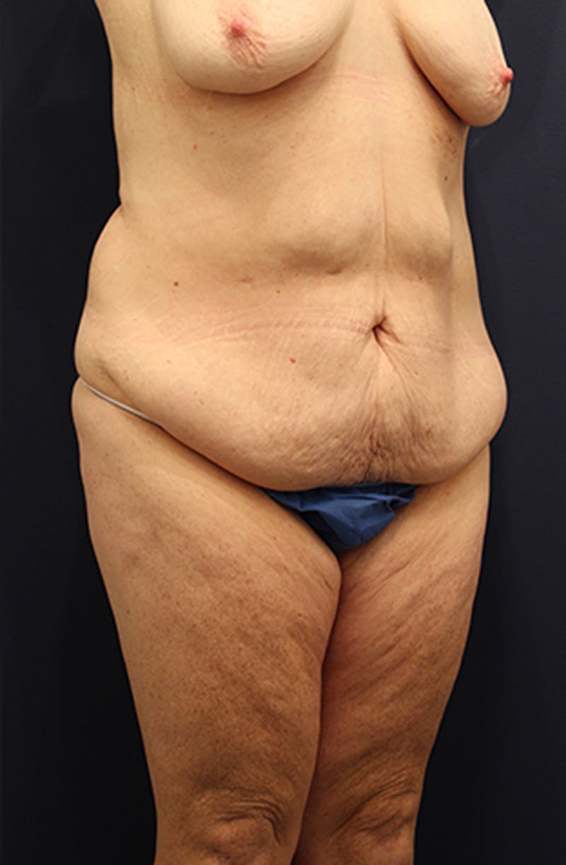 Tummy Tuck Before & After Gallery - Patient 174179769 - Image 3