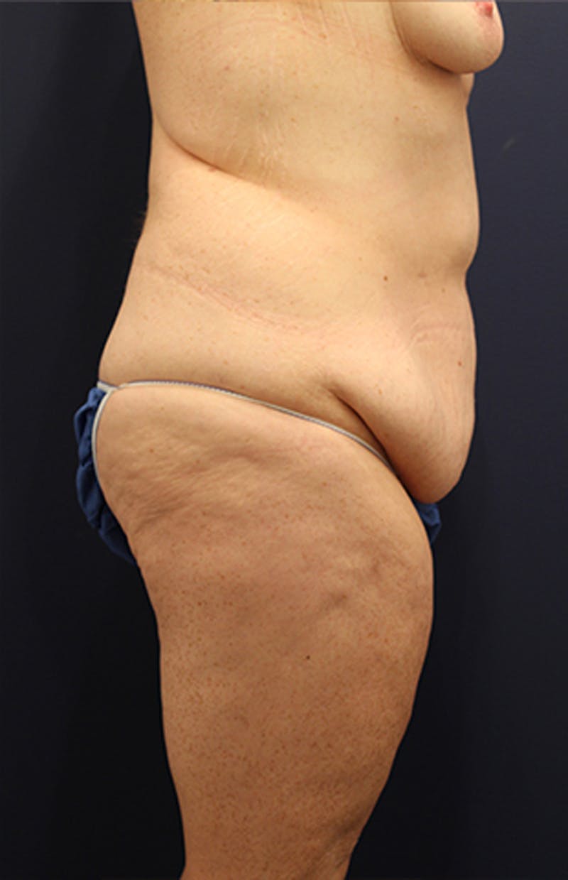 Tummy Tuck Before & After Gallery - Patient 174179769 - Image 5