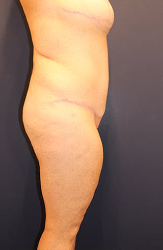 Tummy Tuck Before & After Gallery - Patient 174179769 - Image 6