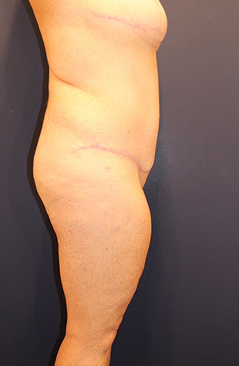 Tummy Tuck Before & After Gallery - Patient 174179769 - Image 6