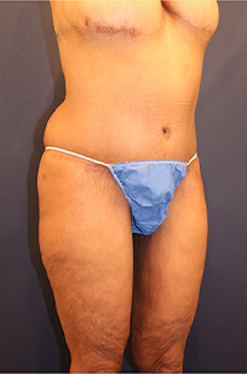 Tummy Tuck Before & After Gallery - Patient 174179771 - Image 2