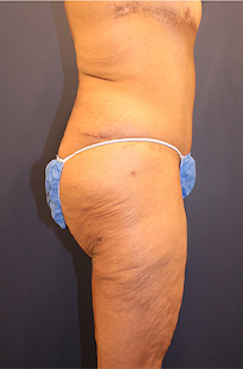 Tummy Tuck Before & After Gallery - Patient 174179771 - Image 6