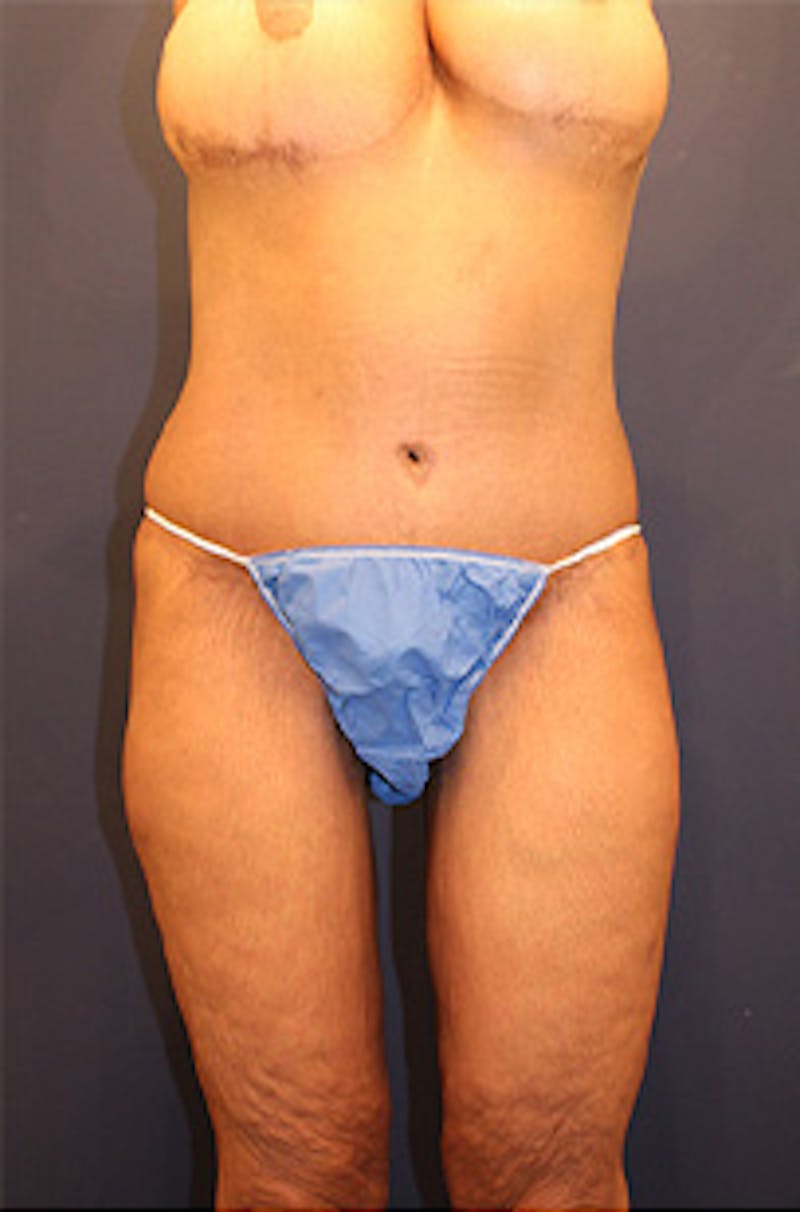 Tummy Tuck Before & After Gallery - Patient 174179771 - Image 4