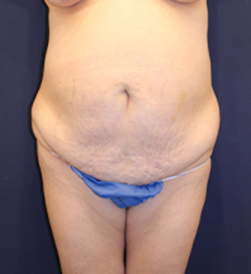 Tummy Tuck Before & After Gallery - Patient 174179772 - Image 1