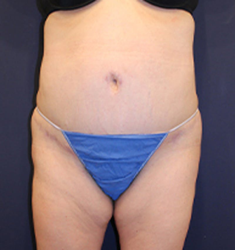 Tummy Tuck Before & After Gallery - Patient 174179772 - Image 2