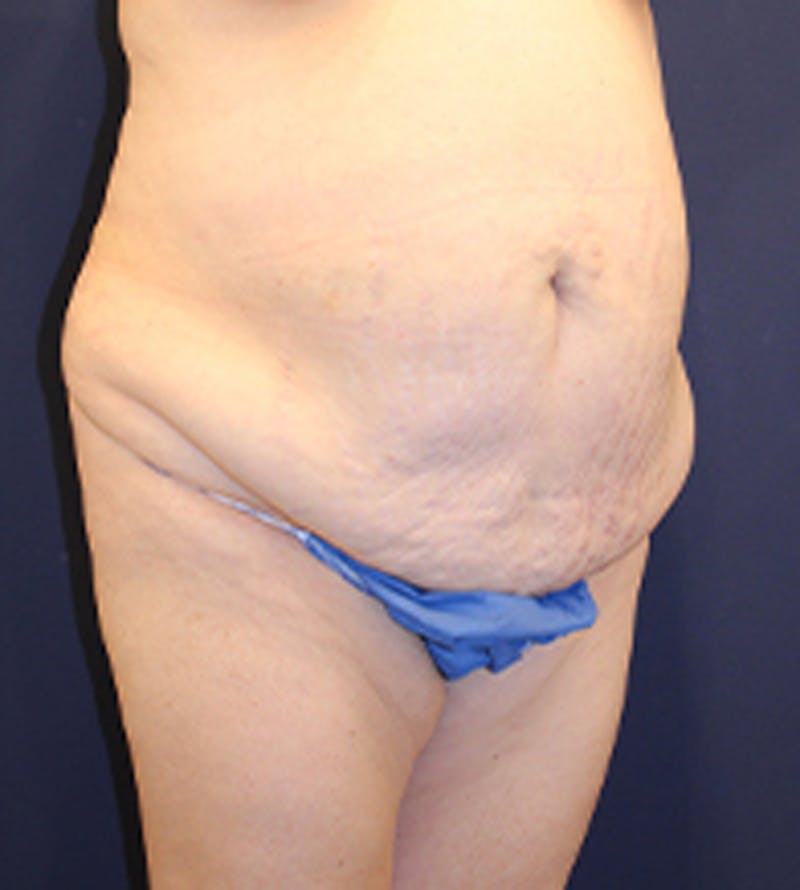 Tummy Tuck Before & After Gallery - Patient 174179772 - Image 3
