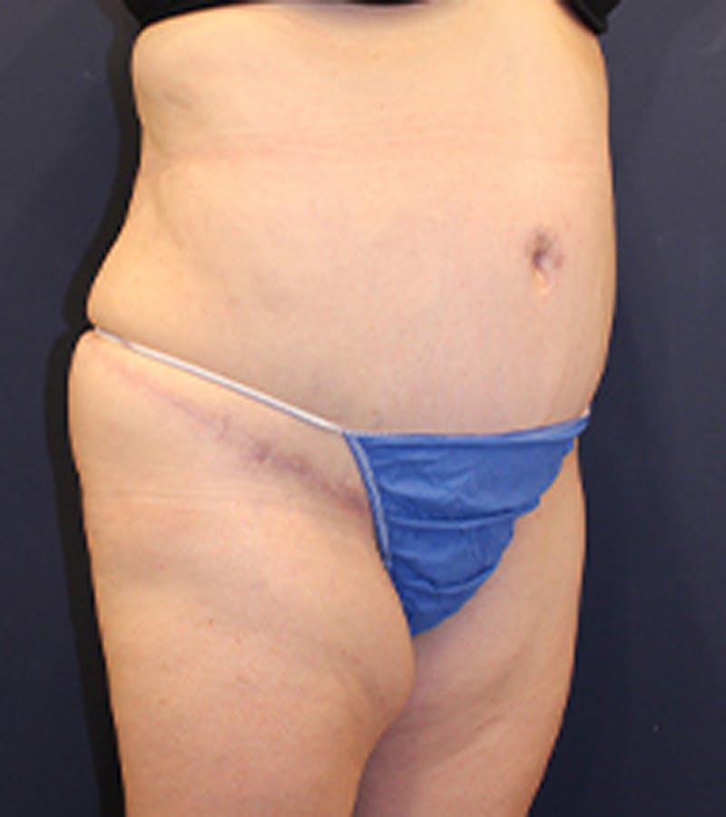 Tummy Tuck Before & After Gallery - Patient 174179772 - Image 4