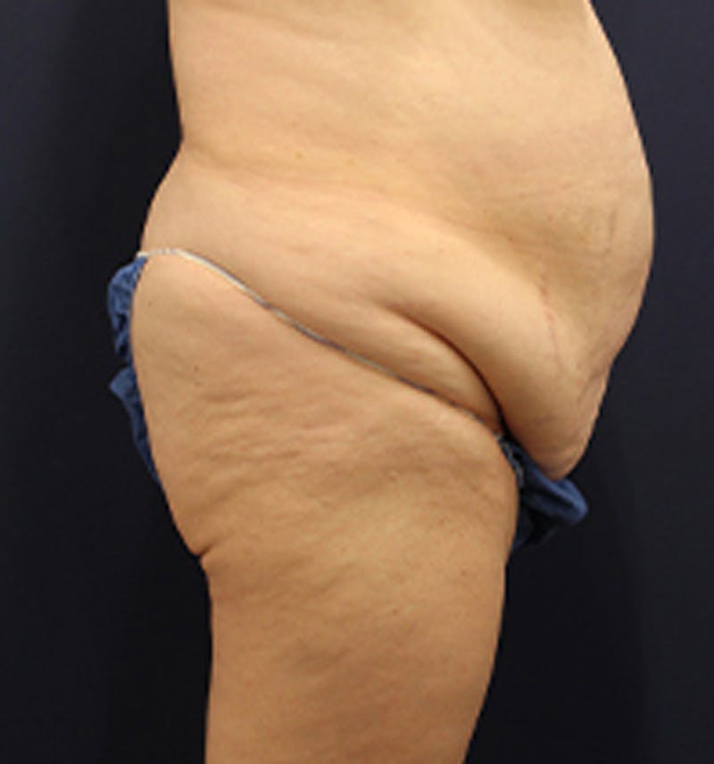Tummy Tuck Before & After Gallery - Patient 174179772 - Image 5