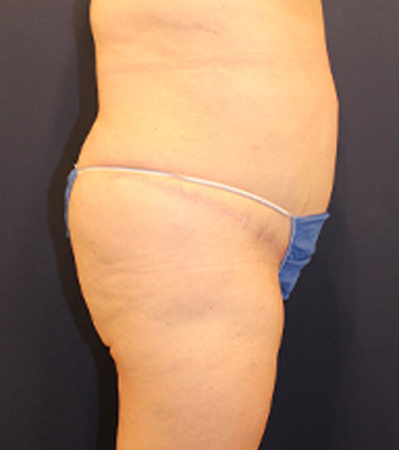 Tummy Tuck Before & After Gallery - Patient 174179772 - Image 6
