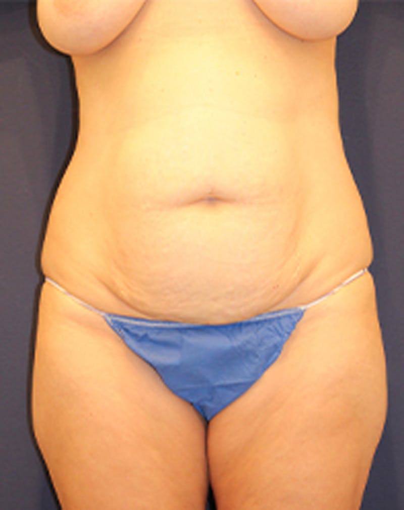 Tummy Tuck Before & After Gallery - Patient 174179773 - Image 1