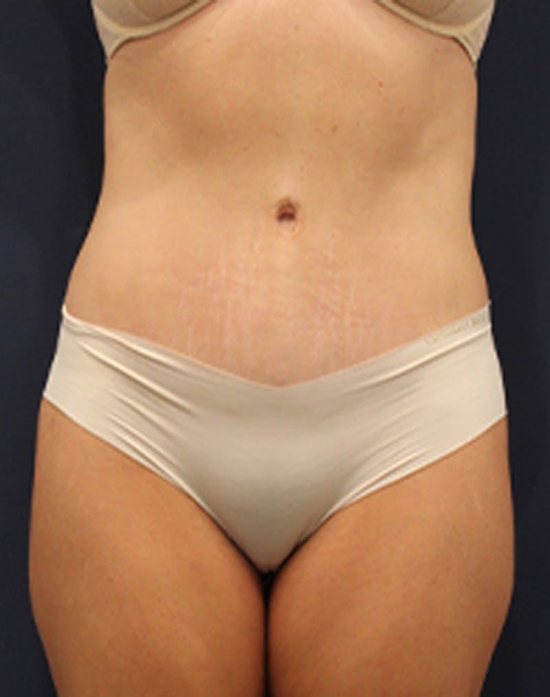 Tummy Tuck Before & After Gallery - Patient 174179773 - Image 2
