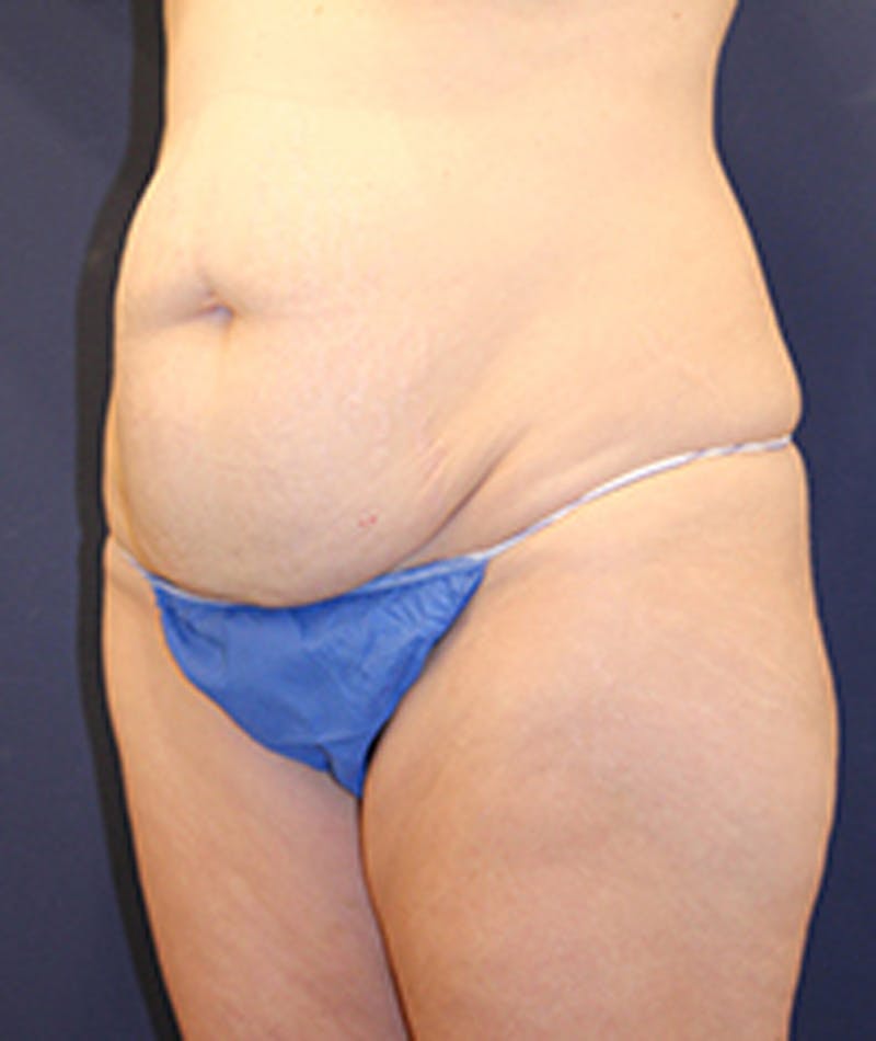 Tummy Tuck Before & After Gallery - Patient 174179773 - Image 3