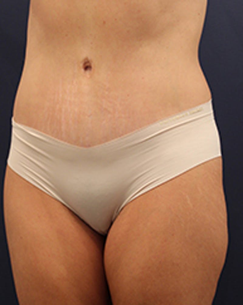 Tummy Tuck Before & After Gallery - Patient 174179773 - Image 4