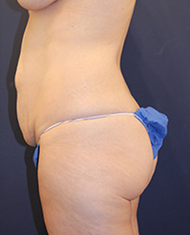 Tummy Tuck Before & After Gallery - Patient 174179773 - Image 5