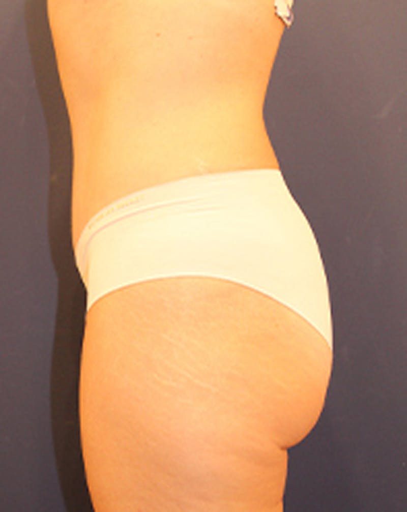 Tummy Tuck Before & After Gallery - Patient 174179773 - Image 6