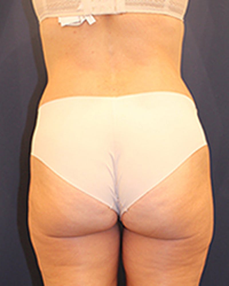 Tummy Tuck Before & After Gallery - Patient 174179773 - Image 8